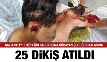 Gaziantep’te köpeğin saldırısına uğrayan çocuğun kafasına 25 dikiş atıldı